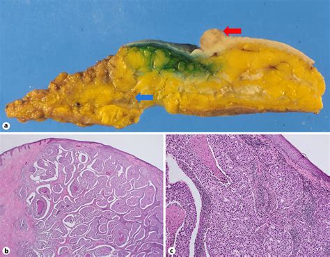 Macroscopic And Histopathological Findings Of The Resected Specimen A