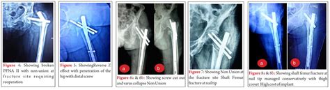 Intramedullary Nail Versus Dynamic Hip Screw Intramedullary Nail