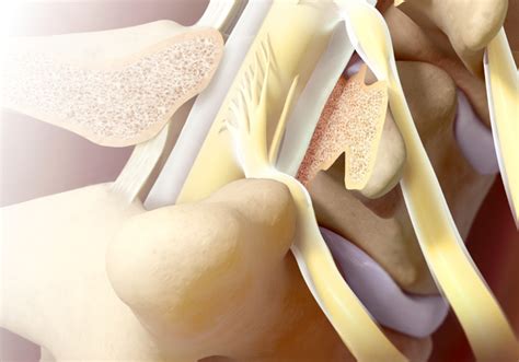 Pre And Post Lysis Procedure Best Practices Racz EDU