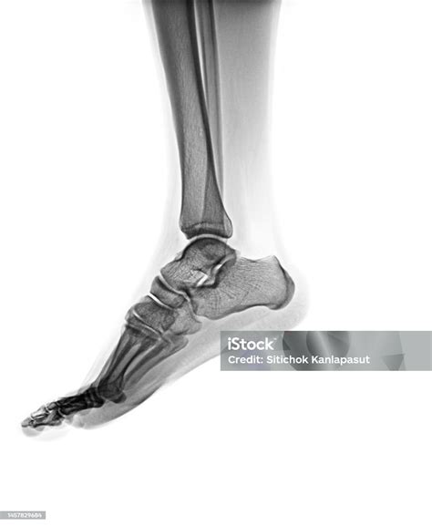 Radiografía Normal Del Pie Humano Vista Lateral Foto De Stock Y Más