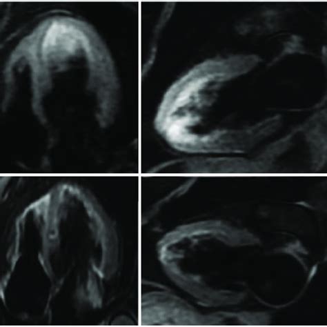 Upper Cine Cardiac Magnetic Resonance Imaging Three Chamber View