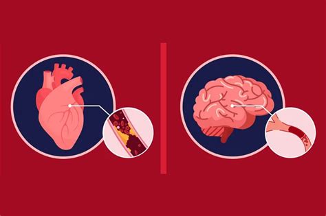 Stroke vs. Heart Attack: Know the Signs & Symptoms - HealthyWomen