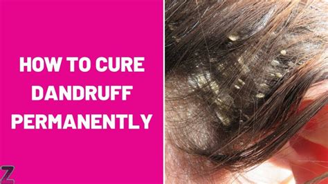 How To Get Rid Of Dandruff Naturally Ask The Nurse Expert