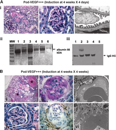 Increased Vegf Expression By Podocytes In Adult Glomeruli Leads To