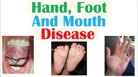 Hand Foot And Mouth Disease Pathophysiology