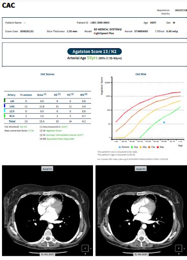 AVIEW CAC Coronary Artery Calcification - Ferrum Health