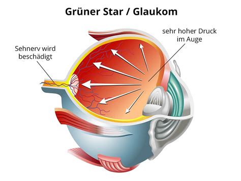 Gr Ner Star Glaukom Augenzentrum Ffb