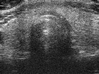 Thyroid Ultrasound - UDS