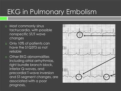 PPT - Pulmonary Embolism Presentation to Diagnosis PowerPoint ...