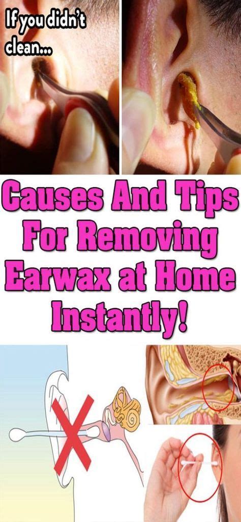 Causes And Tips For Removing Earwax At Home Instantly Removing