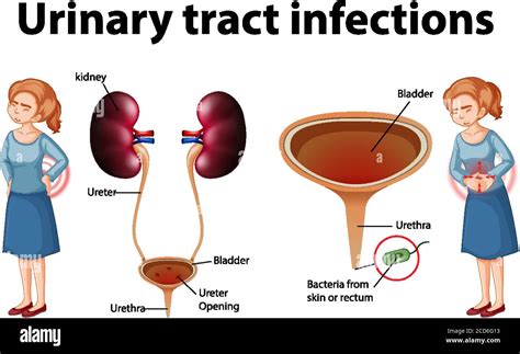 Informative Illustration Of Urinary Tract Infections Illustration Stock