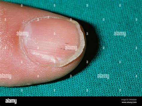 Endocarditis In Fingernail Close Up Of A Finger Nail Showing Splinter