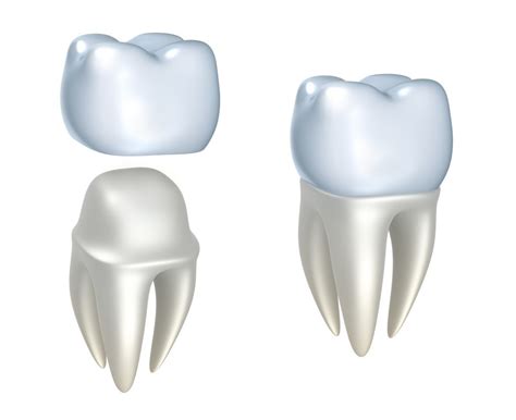 Crowns, Bridges & Dentures | Braddon Dental