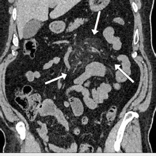 Axial Ct Image Shows Increased Attenuation Of The Mesenteric Fat