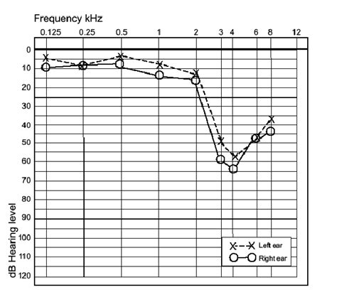 Typical Audiogram Showing A Noise Induced Hearing Loss Download