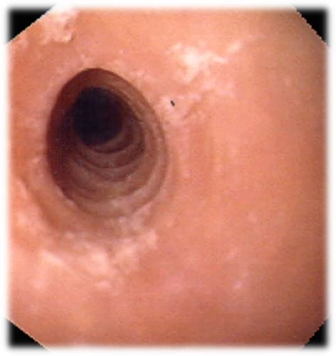 Dysphagia Week 7 Flashcards Quizlet