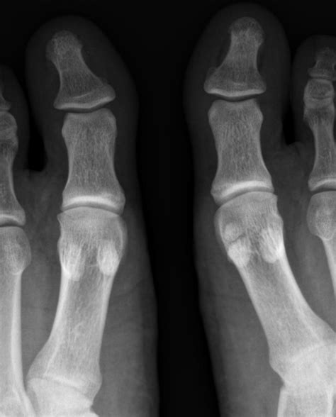 Bipartite Hallux Sesamoid Image Radiopaedia Org