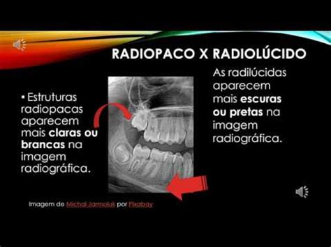 Bin Mios Radiopaco X Radiol Cido Youtube