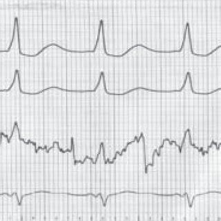 AF in WPW. Note irregularly irregular rhythm with delta wave visible in ...