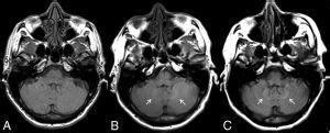 Evidence For Gadolinium Retention In The Human Brain Ajnr News Digest