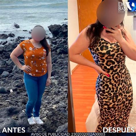 Brazilian Butt Lift Results Dr Baja