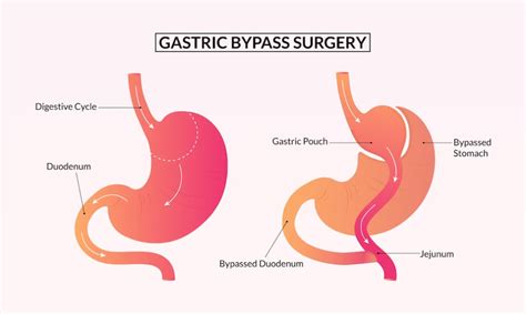 Gastric By Pass Surgery In Turkey Improve Your Health