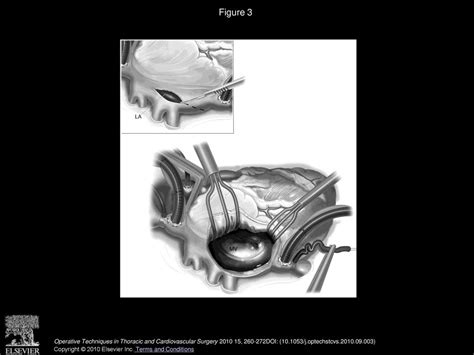 Repair Of Congenital Mitral Valve Insufficiency Ppt Download