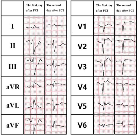 Anterior St Segment Elevation Myocardial Infarction Without St