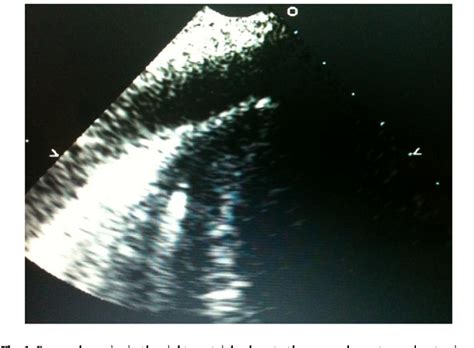 Ventricular Septal Perforation | Semantic Scholar