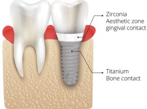 TBR Dental Z1 Tissue Level Implants Tbrdental