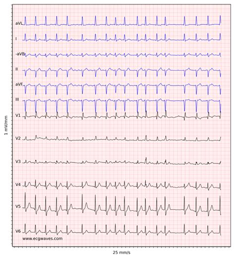 Atrial fibrillation: ECG, classification, causes, risk factors ...