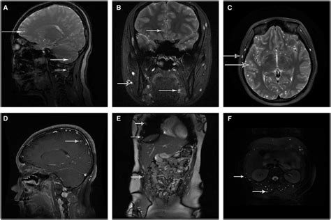 A B C And D Magnetic Resonance Imaging Of The Head March 2018