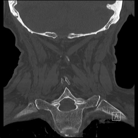 Fileodontoid Fracture Anderson And Dalonzo Type 2 Roy Camille Type 3 Radiopaedia 88041