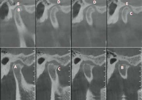 Temporomandibular Joint Cone Beam Computed Tomography A Bone