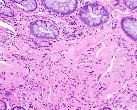 Granular Cell Tumor Colon