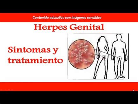 HERPES GENITAL Síntomas y tratamiento del Herpes Genital YouTube