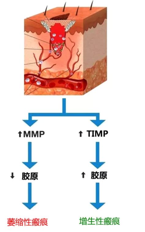 哪些痘痘容易留疤 商进副主任医师 爱问医生