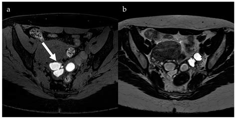 Deep Pelvic Endometriosis A Multidisciplinary Approach 2
