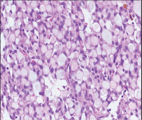 Microcystic Stromal Tumor MST Of The Ovary A Solid Nodule With