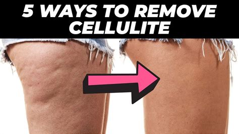 5 Easy Ways To Get Rid Of Cellulite For Good Youtube