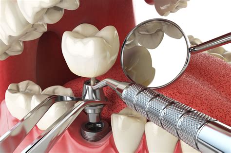 Types Of Dental Implants An In Depth Overview