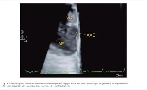 SciELO Brasil Apêndice atrial esquerdo imagem ecocardiográfica