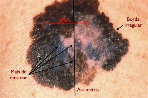 Como através de alguns sinais identificar câncer de pele