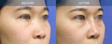 Rhinoplasty Case 1870 Radiance Surgery Aesthetic Medicine