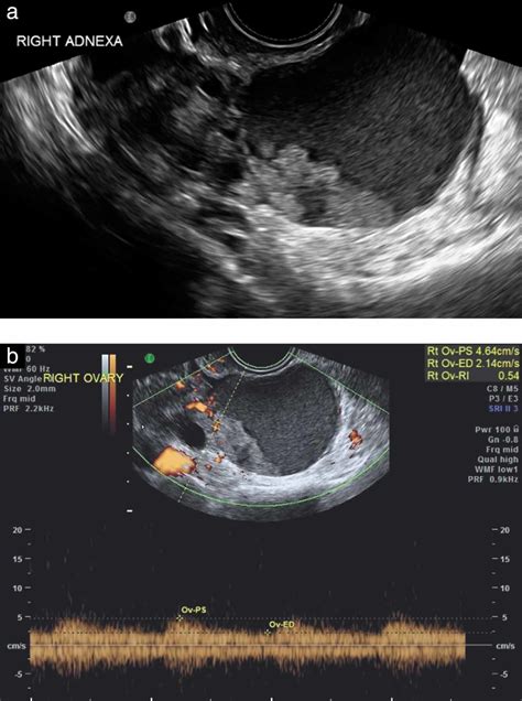 Endometrioid Ovarian Carcinoma In A Woman With A History Of Infertility