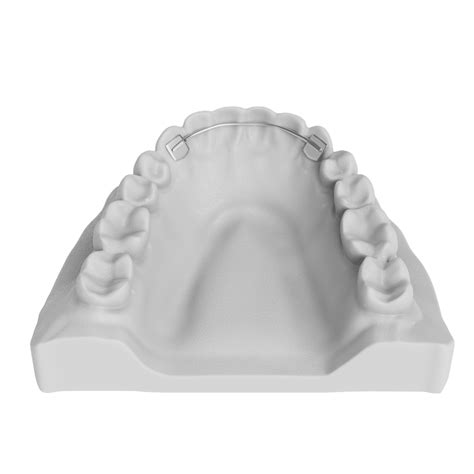 Fixed Lingual Retainers ODL Orthodontic Labs