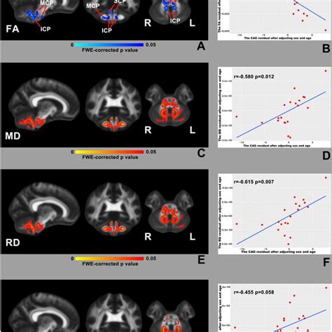 Comparison Of Dti Fa Md Ad And Rd And Fw Imaging Fat Mdt Adt