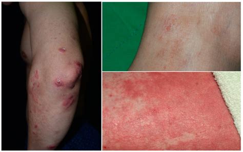 Overlapping Features Of Psoriasis And Atopic Dermatitis From Genetics