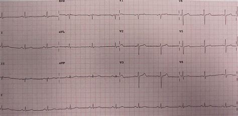 Wellens' syndrome - wikidoc