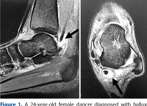 Figure 1 From Posterior Ankle Impingement Syndrome In Athletes